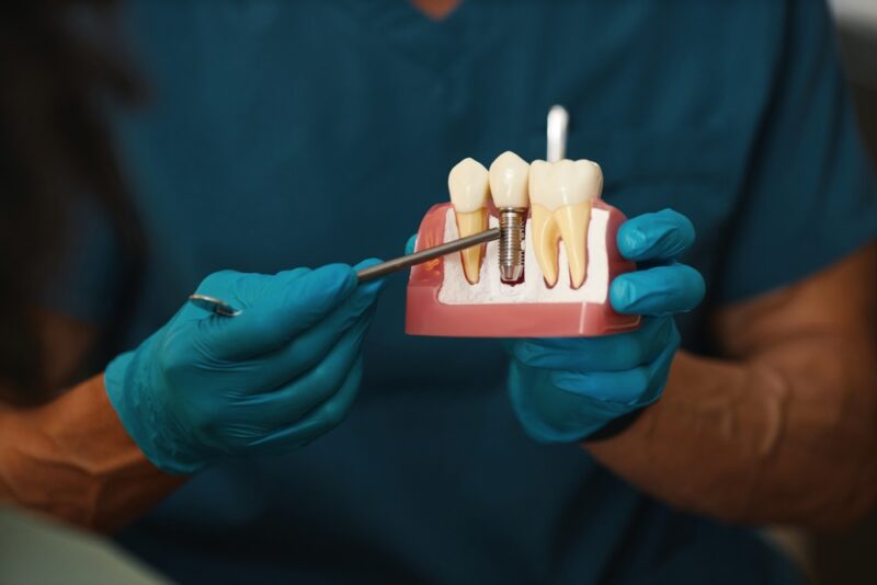 Dental Implants Allen